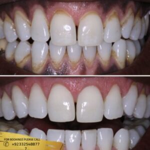 Gum Depigmentation cost in Islamabad