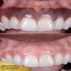 Results of Gum Depigmentation