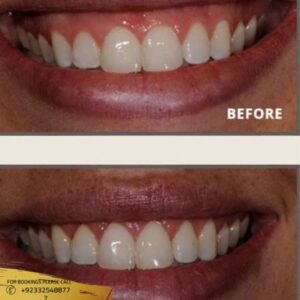 Gummy Smile Treatment before and after