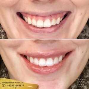 Gummy Smile Treatment cost in Islamabad