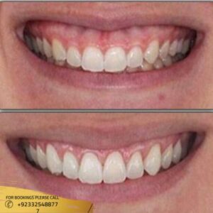 Results of Gummy Smile Treatment