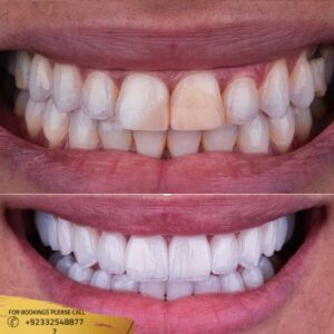 Hollywood Smile design before and after