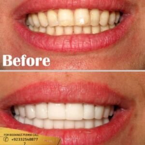 Hollywood Smile design cost in Islamabad