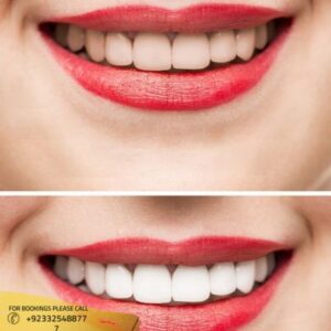 Results of Hollywood Smile design