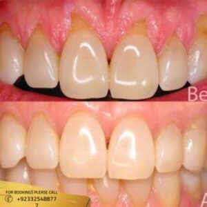 Gum Recession Treatment cost in Islamabad