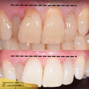 Results of Gum Recession Treatment