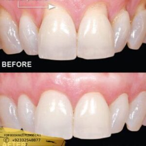 Gum Recession Treatment before and after