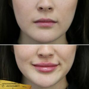 Lip augmentation cost in Islamabad