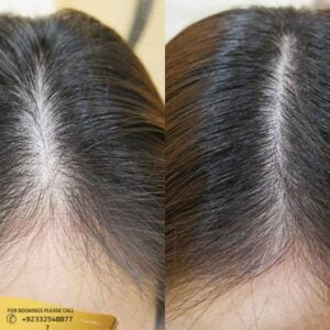 Hair Fillers Treatment before and after