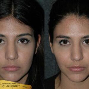 Results of Facial Treatment