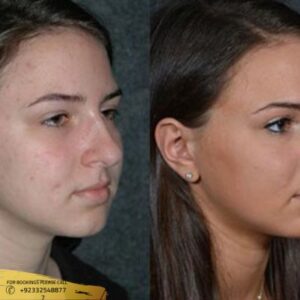 Facial Treatment before and after