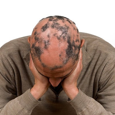 What is alopecia areata and how it can be managed?