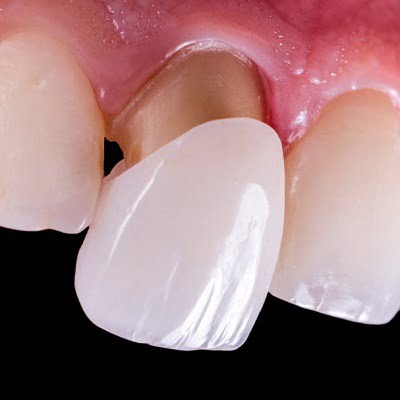 Dental Veneers vs Crowns Understanding the Differences