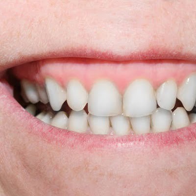 Gum Depigmentation for a Confident Smile