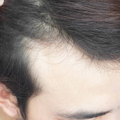 Reasons Of Hair Loss After Surgery