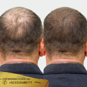 Price of PRP Hair treatment in islamabad