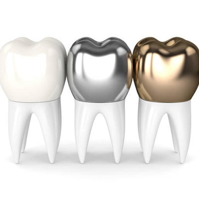 Pros & Cons of Dental Crowns