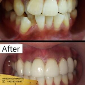 Results of Teeth Aligners