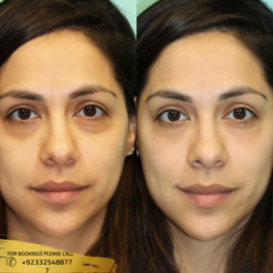 Undereye Fillers cost in Islamabad