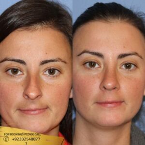 Results of septoplasty surgery