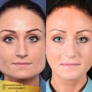 chin augmentation before and after