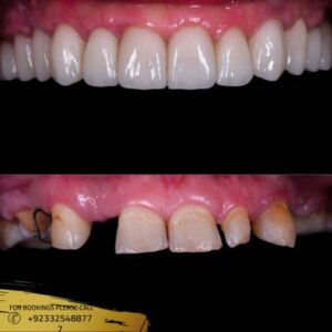 Zirconia Crown cost in Islamabad