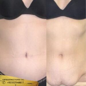 Results of Abdominoplasty