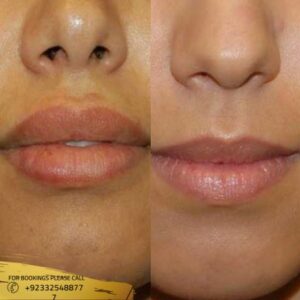 Lip Reduction Surgery before and after