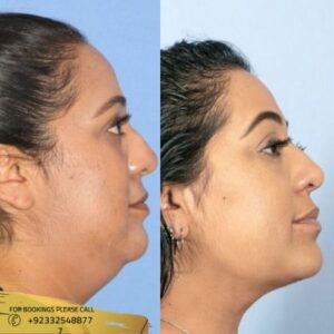 Results of Buccal Fat Removal