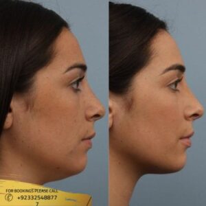 Buccal Fat Removal cost in Islamabad