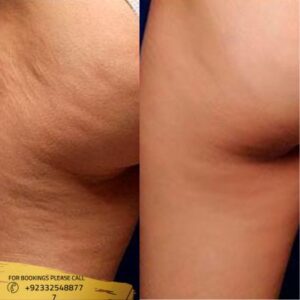 Results of cellulite removal