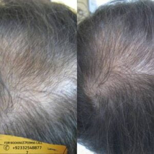 Mesotherapy for Hair Loss cost in Islamabad