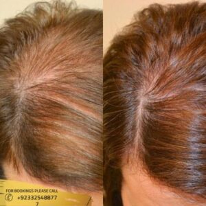 Results of Mesotherapy for Hair Loss