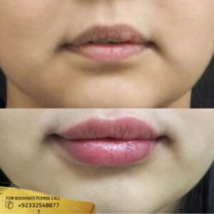 Results of Lip augmentation