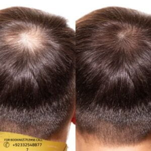 Results of Alopecia Areata Treatment