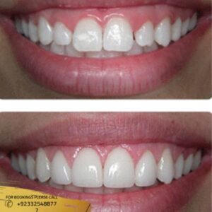 gum grafting before and after