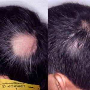 Alopecia Areata Treatment before and after