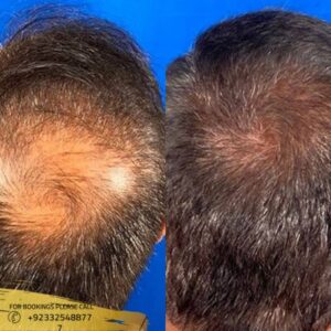 Alopecia Areata Treatment cost in Islamabad