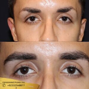 Eyebrow transplant cost in Islamabad