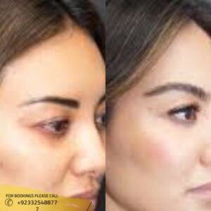 Eyebrow transplant before and after