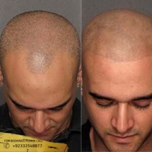 Scalp Micropigmentation before and after