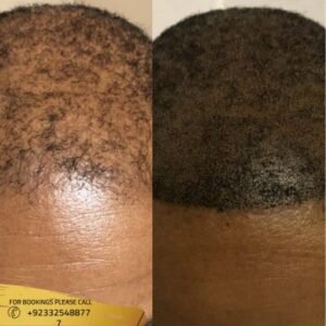 Scalp Micropigmentation cost in Islamabad