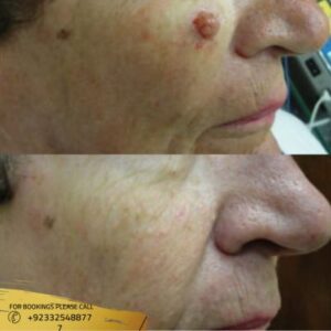 Results of Skin Tag Removal