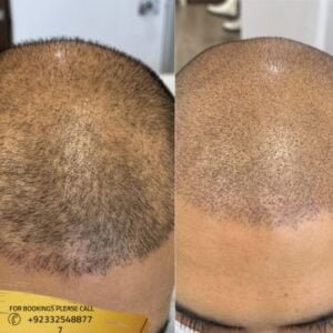 Results of Scalp Micropigmentation