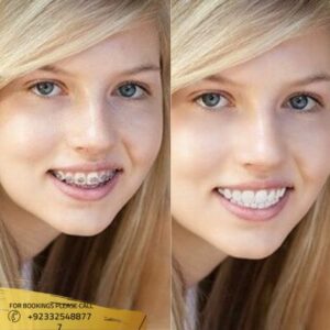 Dental Braces before and after