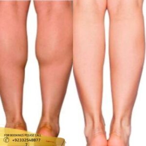 Calf Reduction cost in Islamabad