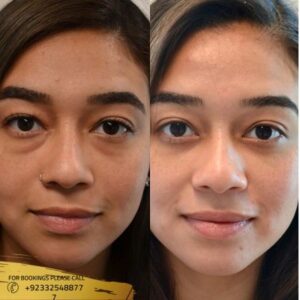 Eye Bag Removal before and after