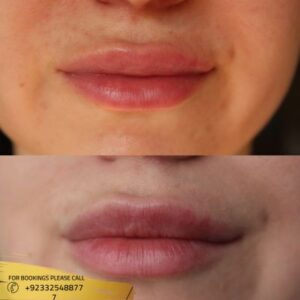 Lip augmentation before and after