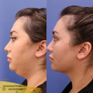 Buccal Fat Removal before and after