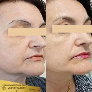 Laser Skin Tightening before and after